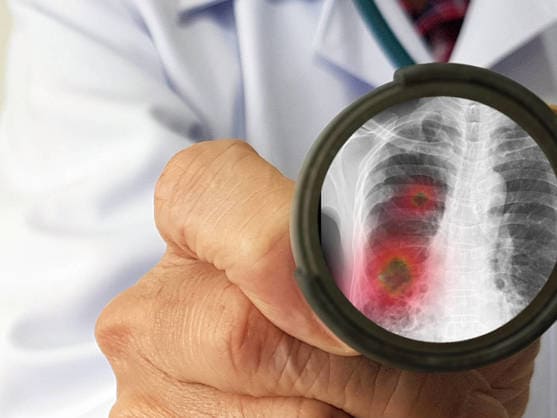 Preguntas y Respuestas sobre el Coronavirus